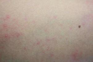 malata eruzione cutanea allergica dermatite eczema pelle del paziente foto