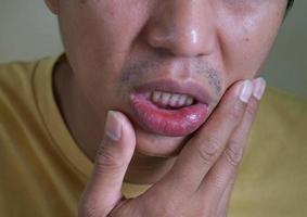 primo piano il labbro dell'uomo ha un'ulcera alla bocca. stomatite sul labbro. concetto di problema di salute. foto
