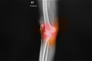 l'articolazione del ginocchio destro a raggi x mostra uno spazio ristretto. foto