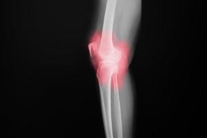 ginocchio a raggi x del film del paziente del ginocchio di osteoartrite e dell'articolazione artificiale foto