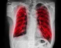 tubercolosi polmonare tb la radiografia del torace mostra infiltrazione alveolare in entrambi i polmoni a causa di un'infezione da tubercolosi da micobatterio. foto