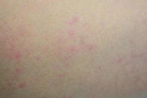 malata eruzione cutanea allergica dermatite eczema pelle del paziente foto