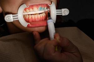 divaricatore in plastica per aumento delle labbra in bocca, procedura odontoiatrica e divaricatore come elemento ausiliario. foto