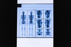 set di scansione tc dello scheletro del corpo intero femminile e degli organi interni. foto