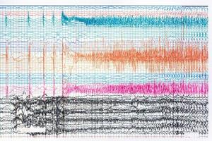 fotografia di ictal eeg durante il sequestro foto