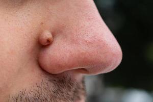 neoplasia sul viso vicino al naso di una persona, simile a una verruca o a un papilloma foto