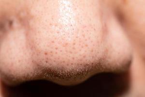 brufoli, acne intasata intorno al naso degli uomini foto