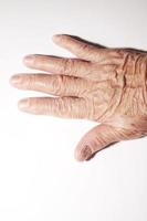 unghia di una donna anziana infetta da un'infezione fungina. foto