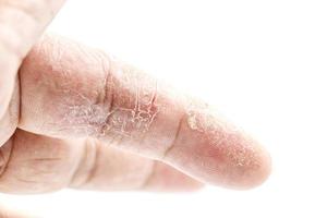 malattia della pelle del dito indice su sfondo bianco foto