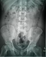 semplice radiografia del tratto urinario vista anteroposteriore che mostra lo stent ureterico destro usato per trattare i calcoli foto