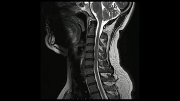 immagini di risonanza magnetica dell'immagine sagittale pesata in t2 della colonna cervicale, colonna vertebrale cervicale RM, che mostra una malattia del disco multiplo, più evidente al disco c5-6. foto