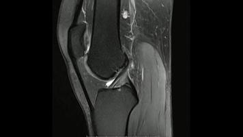 immagini di risonanza magnetica dell'immagine della densità protonica sagittale dell'articolazione del ginocchio, articolazione del ginocchio con risonanza magnetica, che mostra l'anatomia del ginocchio foto