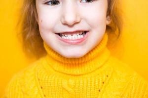 la ragazza mostra i suoi denti-morso patologico, malocclusione, overbite. odontoiatria e parodontologia pediatrica, correzione del morso. salute e cura dei denti, cura della carie, denti da latte. la mascella superiore poggia sulla gengiva. foto