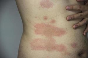 uomo che ottiene un'eruzione cutanea rossa nella sua parte del corpo - persone con problemi di allergia cutanea concetto foto