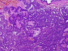 carcinoma tiroideo, immagine al microscopio di carcinoma papillare metastatico della tiroide, linfonodo centrale. foto