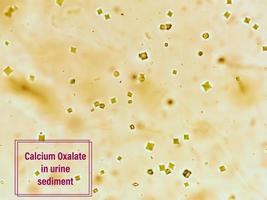 cristallo di ossalato di calcio dal sedimento urinario. foto