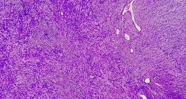 microfotografia di uno schwannoma, un tumore benigno dei tessuti molli della guaina del nervo periferico. foto