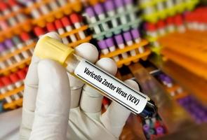 provetta per campioni di sangue per virus varicella zoster o test vzv. foto