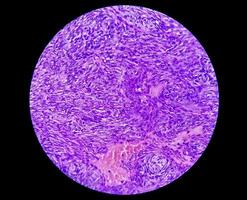 microfotografia di uno schwannoma, un tumore benigno dei tessuti molli della guaina del nervo periferico. foto
