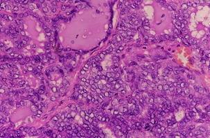 carcinoma tiroideo, immagine al microscopio di carcinoma papillare metastatico della tiroide, linfonodo centrale. foto