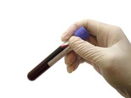 un'immagine di sangue in una provetta per prelievo venoso foto