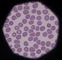 i normali globuli rossi del sangue periferico sono normocitici normocromici foto