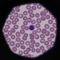 i normali globuli rossi del sangue periferico sono normocitici normocromici foto
