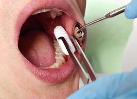il dentista inserisce il tampone