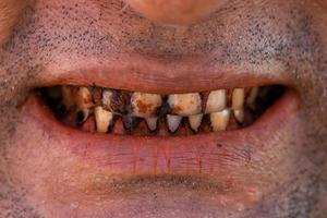 cavità dei denti di placca e paradontosi nella bocca dell'uomo. problemi di carie dentale e cattivo sorriso. concetto di trattamento del dentista. foto