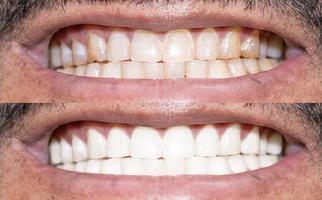 primo piano dei denti di un essere umano sorridente prima e dopo lo sbiancamento foto