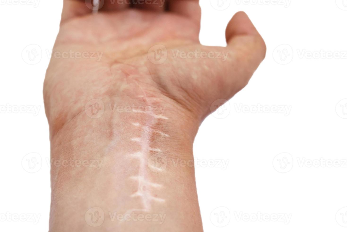 cicatriz com pontos no pulso após a cirurgia. fratura dos ossos das mãos em punho isolado no fundo branco foto