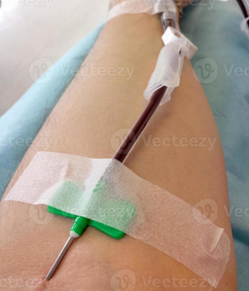 agulha no braço do doador de sangue durante a doação de sangue foto