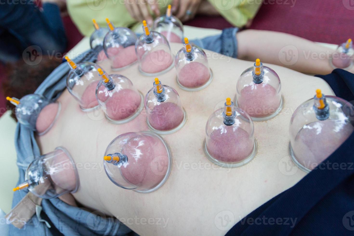 vácuo de pele nas costas, a medicina alternativa chinesa foto