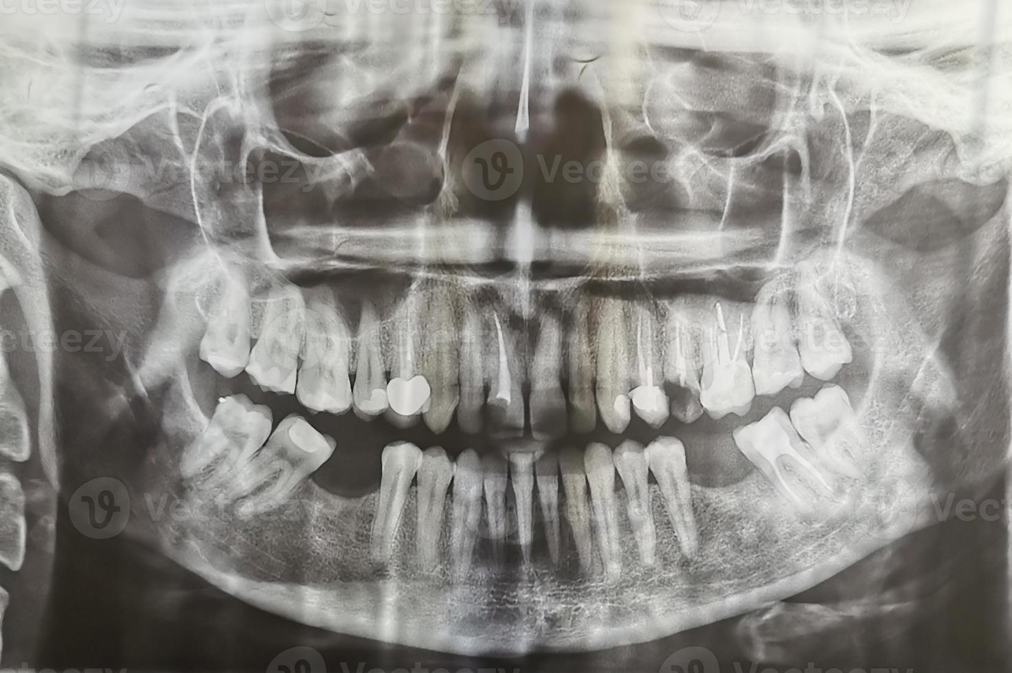 radiografia odontológica. digitalização de dentes de raio-x digital de fêmea adulta. vista frontal de raio-x de dentes humanos foto