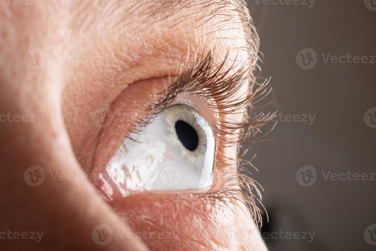 closeup de olho de ceratocone, afinamento da córnea foto