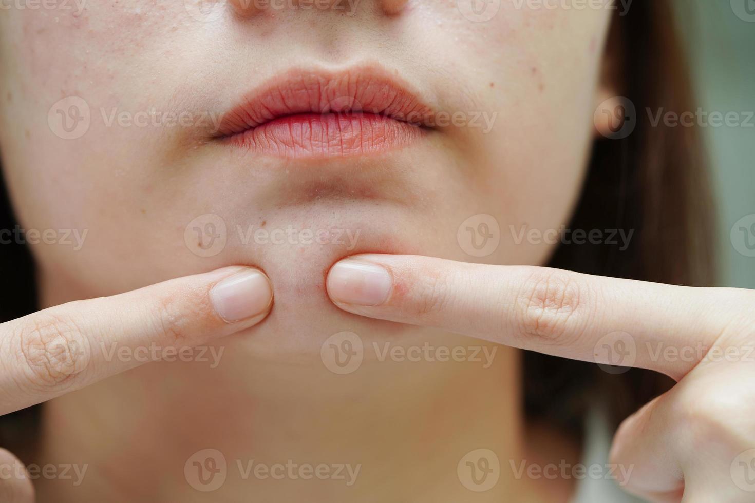 espinha de acne e cicatriz no rosto da pele, distúrbios das glândulas sebáceas, problema de beleza de cuidados com a pele de adolescente. foto