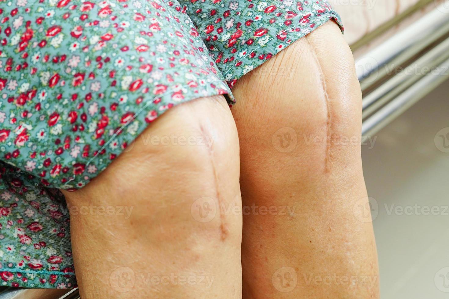 paciente idosa asiática com cirurgia de substituição do joelho cicatriz no hospital. foto