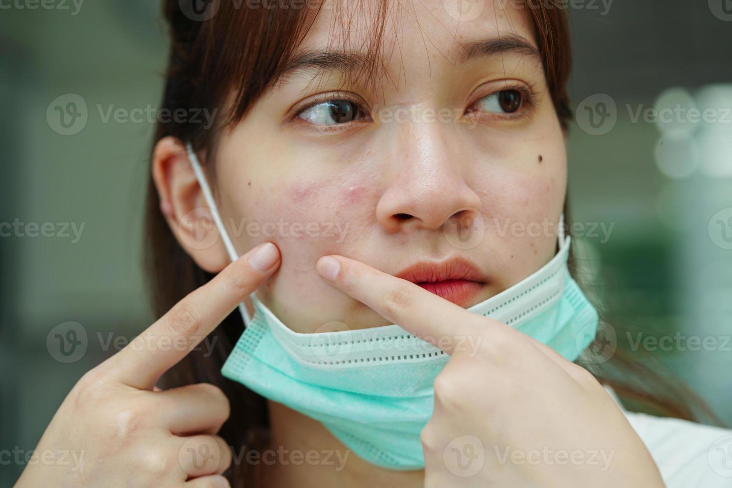 espinha de acne e cicatriz no rosto da pele, distúrbios das glândulas sebáceas, problema de beleza de cuidados com a pele de adolescente. foto