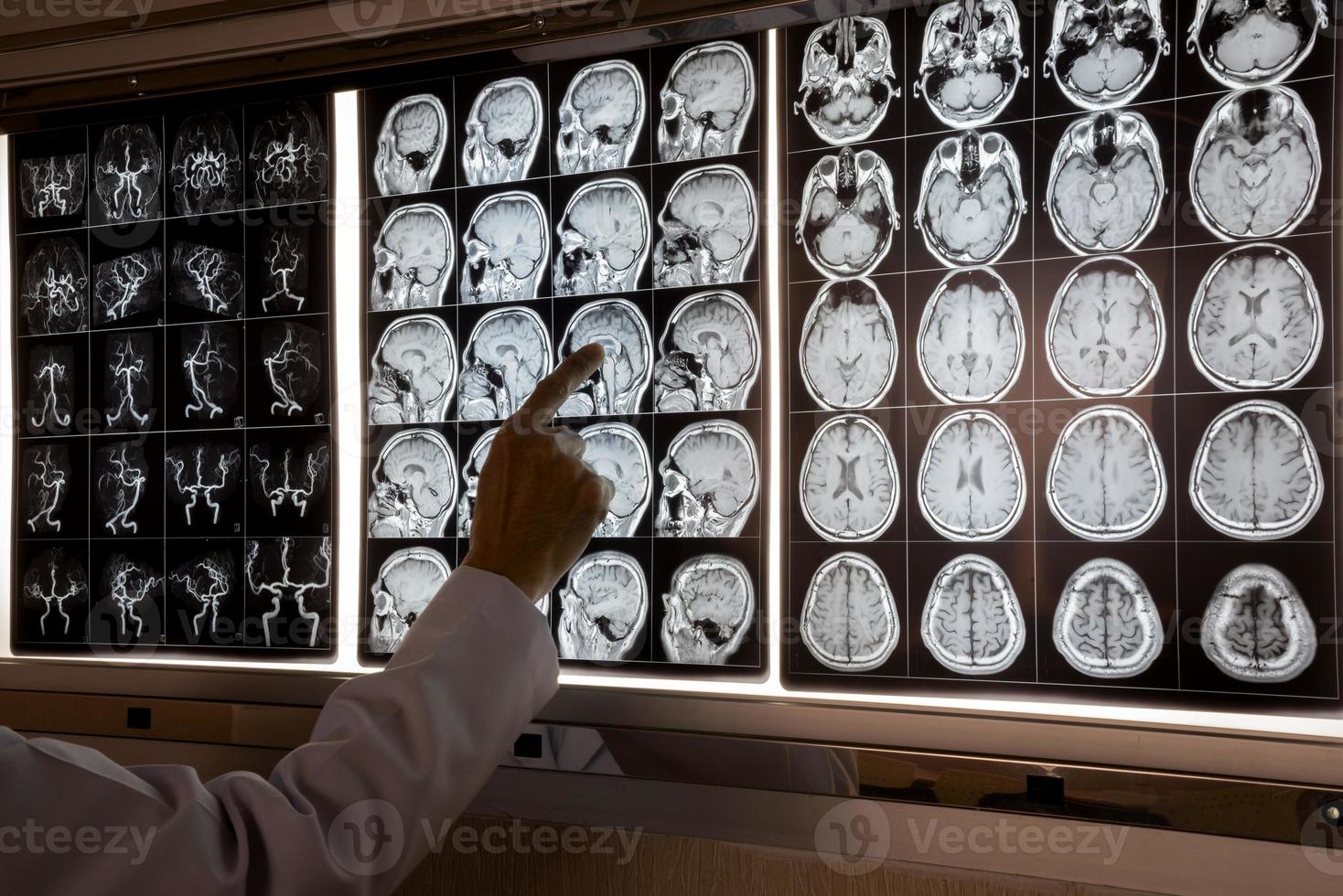 médico apontando para ressonância magnética do cérebro humano foto
