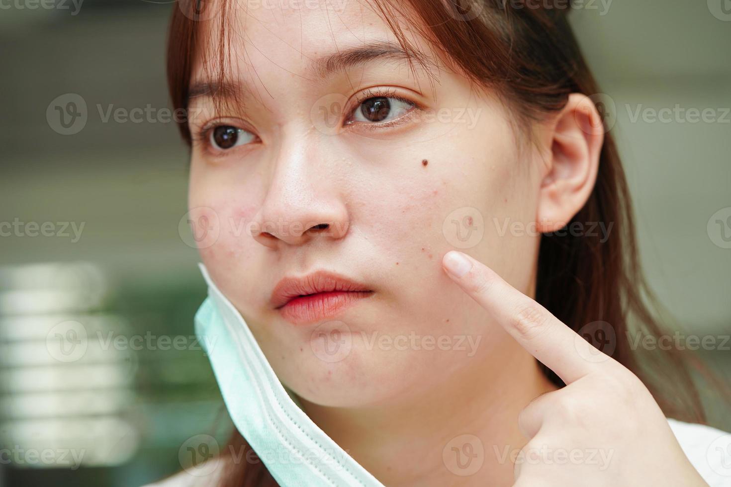 espinha de acne e cicatriz no rosto da pele, distúrbios das glândulas sebáceas, problema de beleza de cuidados com a pele de adolescente. foto