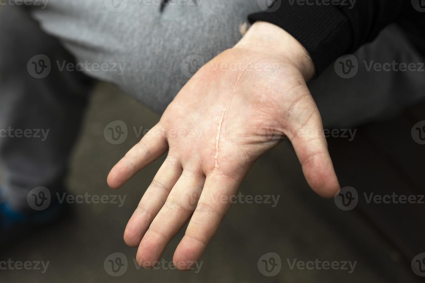 palma com cicatriz. mão de homem com corte. cicatriz na pele. foto