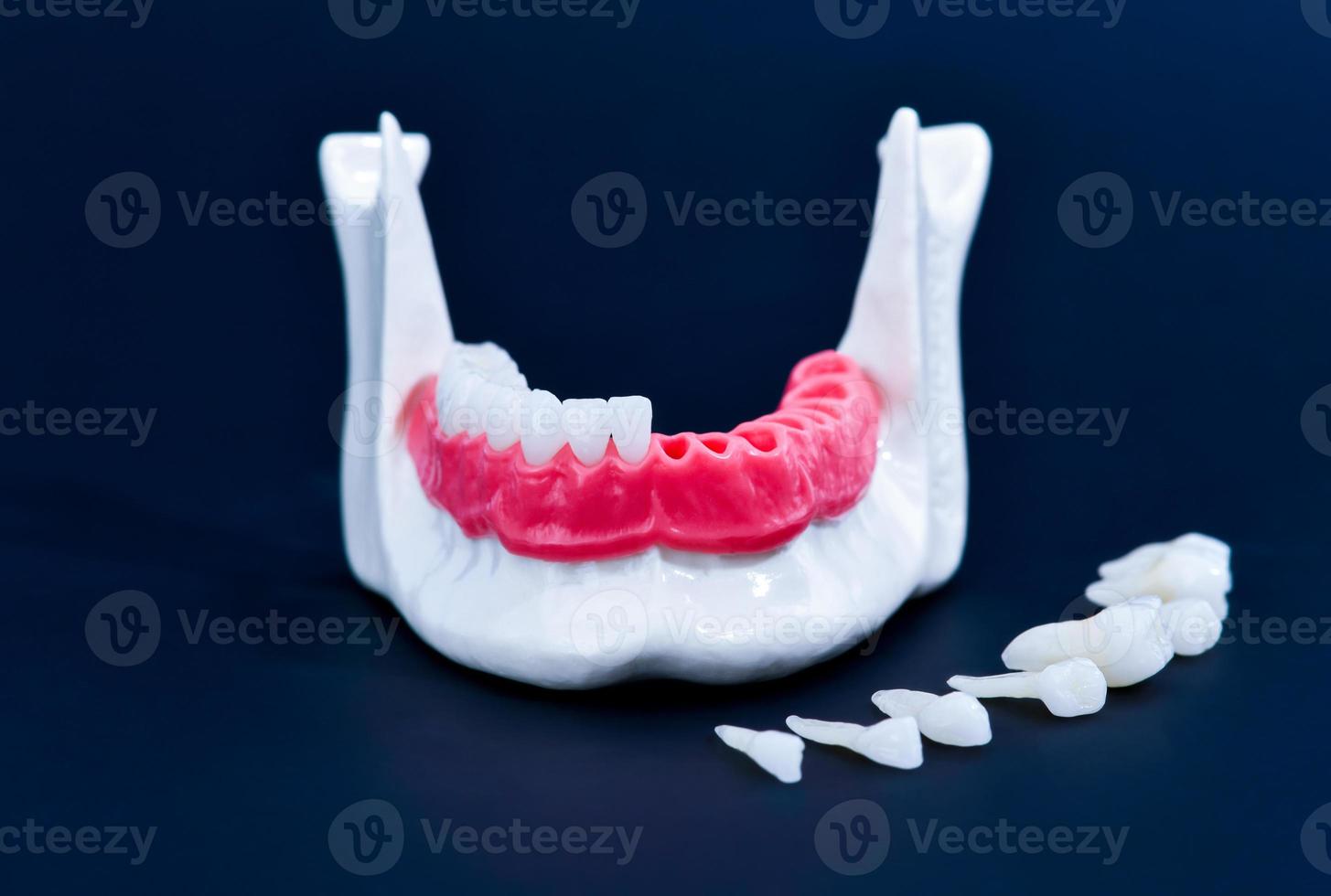 processo de instalação de implante e coroa dentária foto