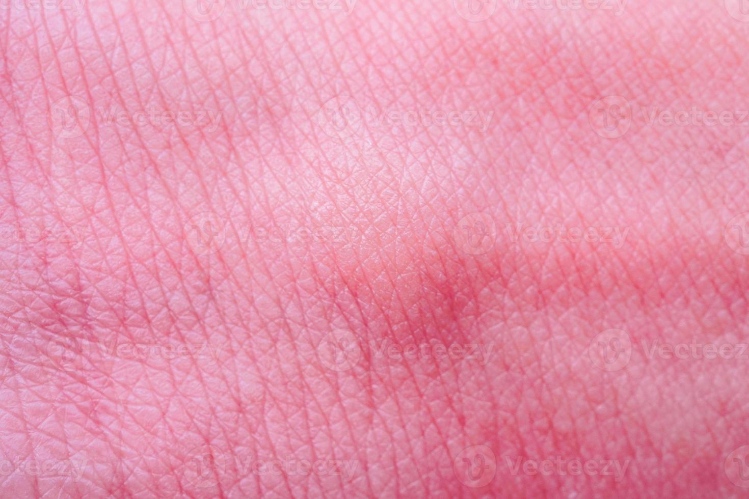 alergia de pele com erupção cutânea após picada de mosquito foto