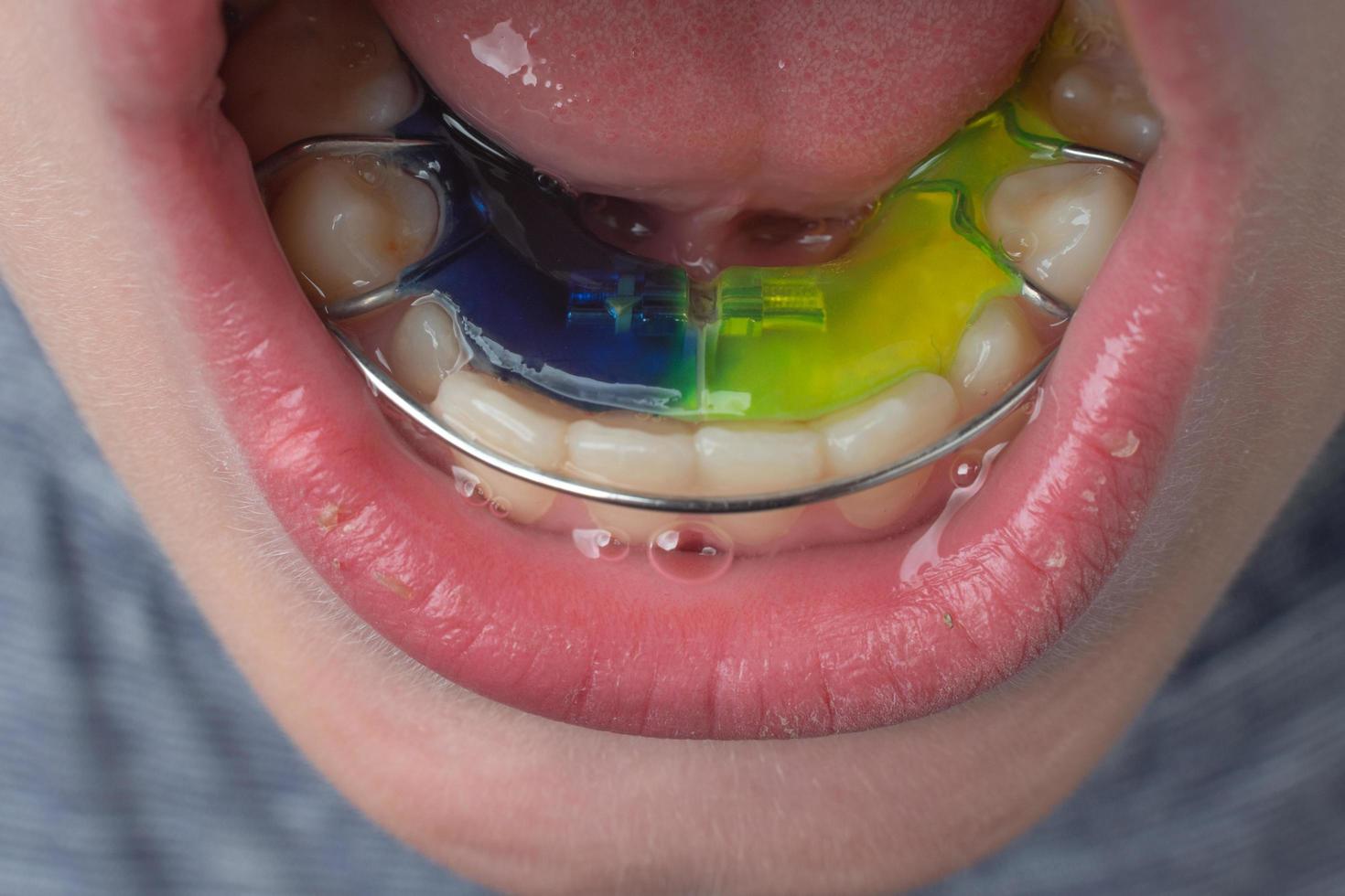 placa mandibular, um menino usa uma placa para alinhar os dentes. foto