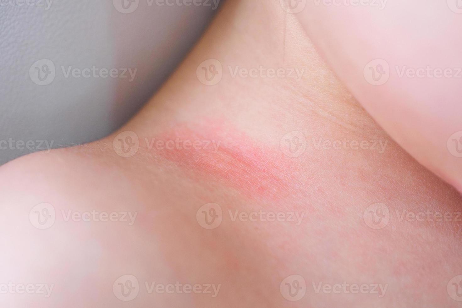 erupção cutânea e alergia de menina asiática com mancha vermelha causada por picada de mosquito no pescoço foto