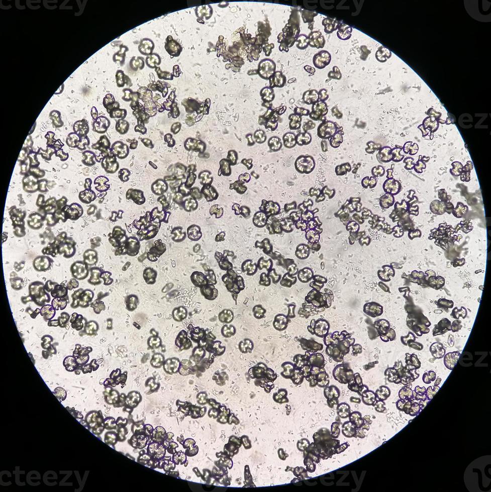 imagem microscópica mostrando oxalato de cálcio monohidratado, cristais de ácido úrico e cristais de fosfato triplo do sedimento urinário. uti. doenca renal. foto