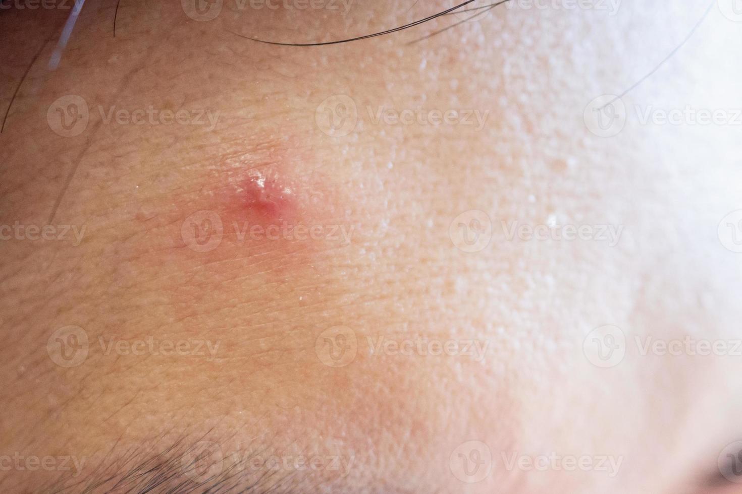 acne inflamatória com mancha vermelha no rosto closeup foto