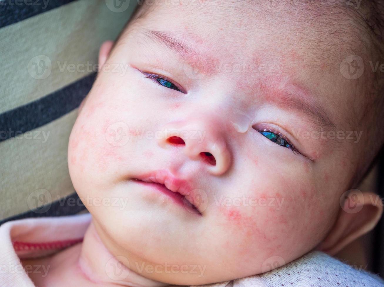 bebê recém-nascido com alergia no rosto foto