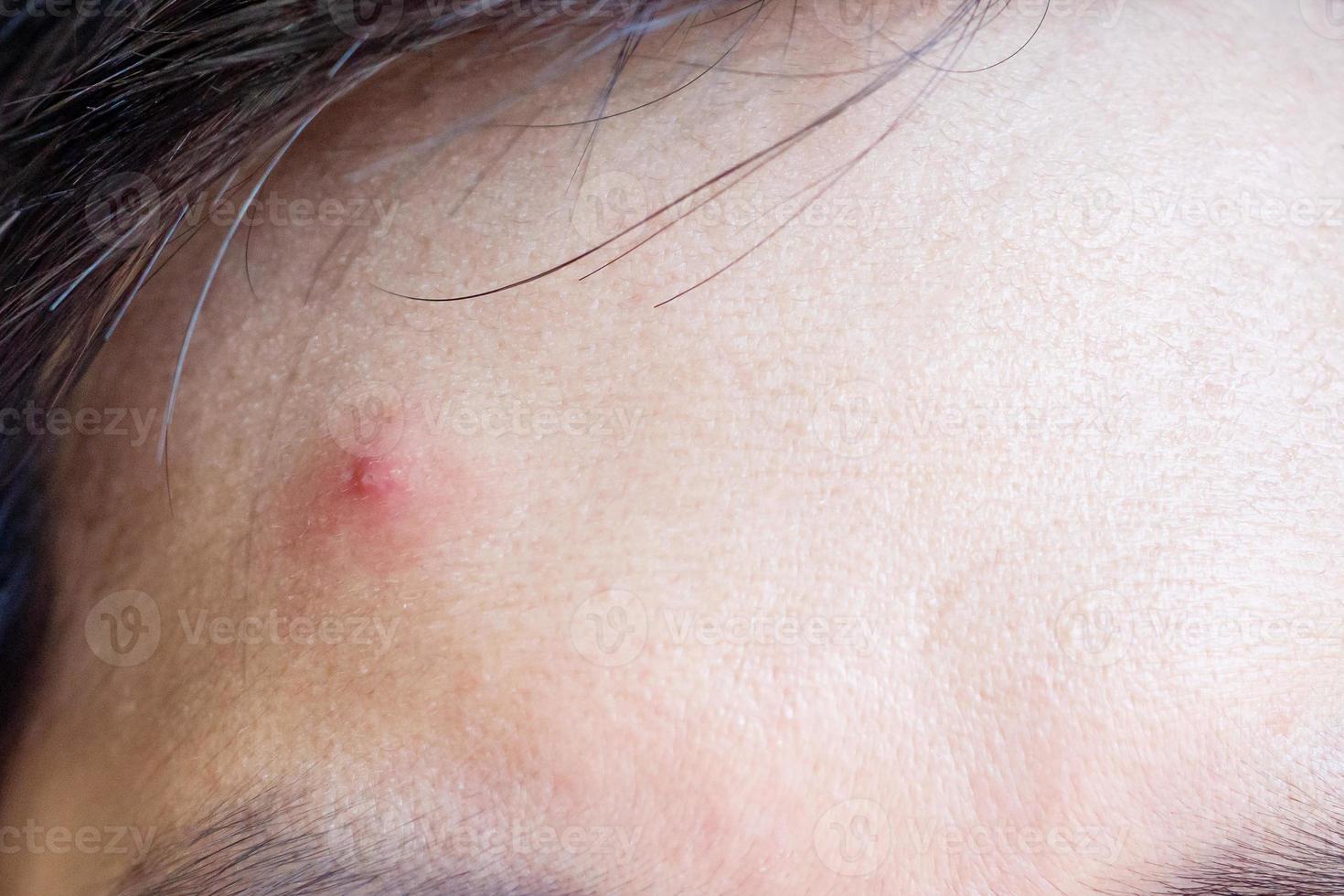 acne inflamatória com mancha vermelha no rosto closeup foto