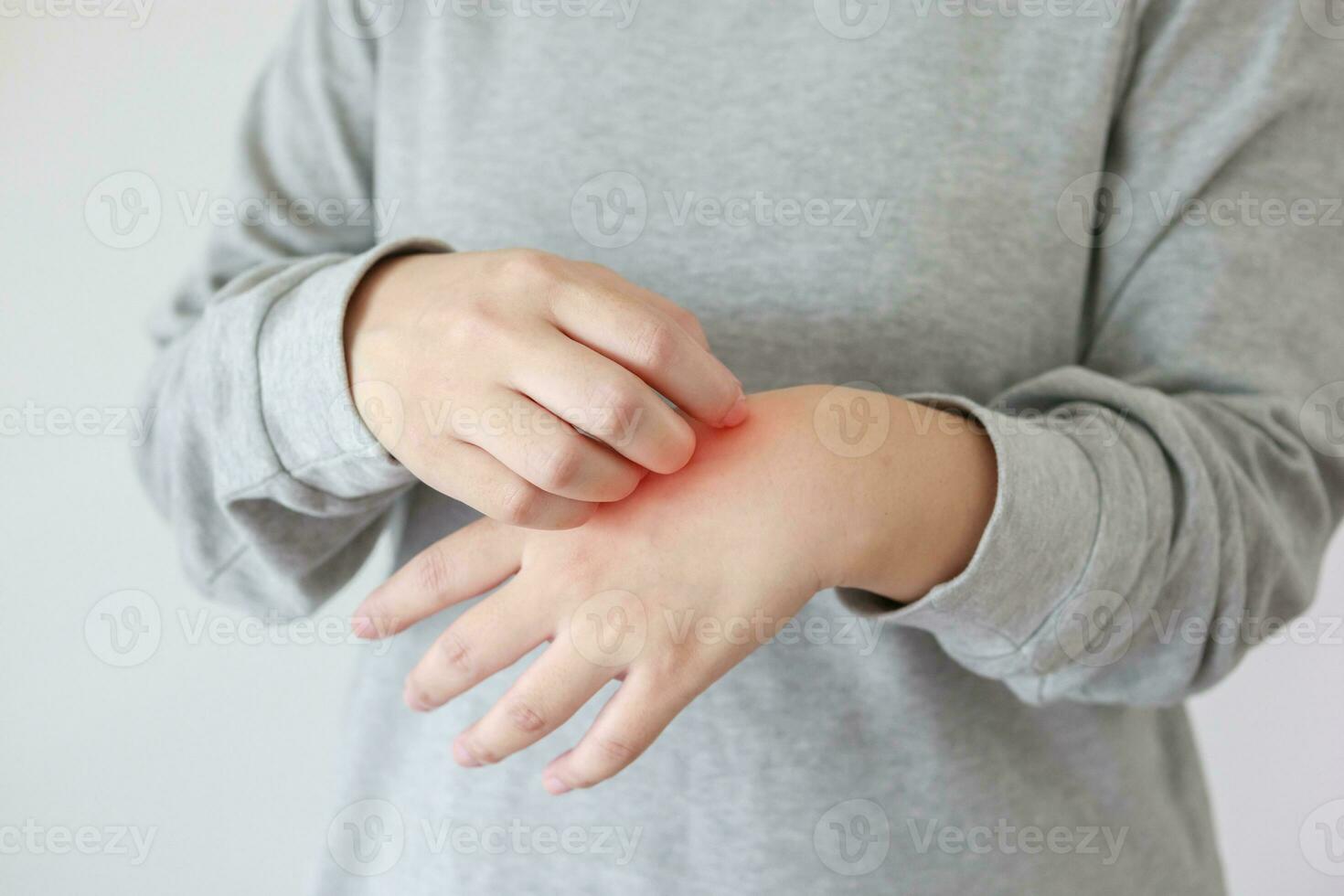 jovem mulher asiática coçando e coçando na mão de dermatite eczema de pele seca com coceira foto